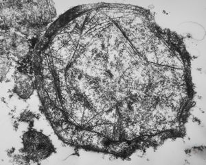 F,76y. | intranuclear needle-like structures - rhabdomyoma,tongue F,76y. | intranuclear needle-like structures - rhabdomyoma,tongue
